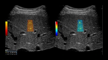 2 liver shear wave elastography with quality indicator