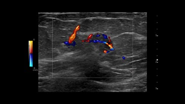 6 breast image with pdi and radiantflowtm