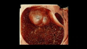 7 ovarian mass 3d render with hdlivetm