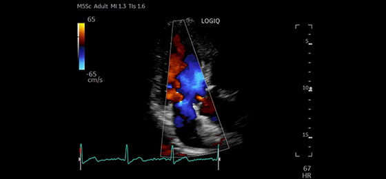 alax-cf-mitral-and-aortic-valves-m5sc-d_560x260
