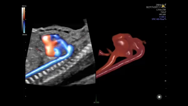 18 week aortic arch thumbnail