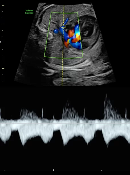 27-week-pulmonary-pulsed-wave