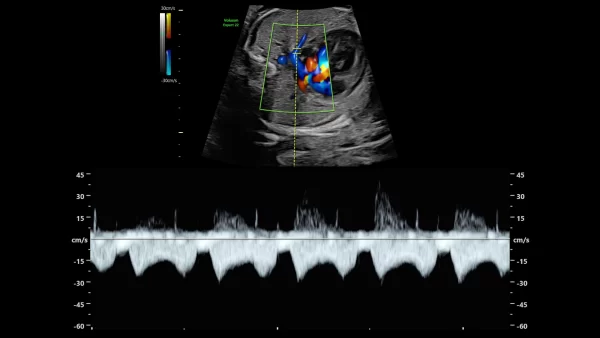 27 week pulmonary pulsed wave