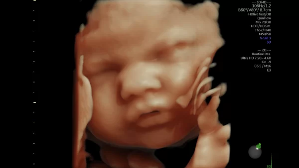 33 week fetal face 03