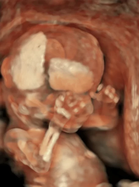 fetus-13week