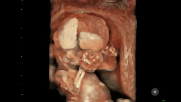 fetus 13week