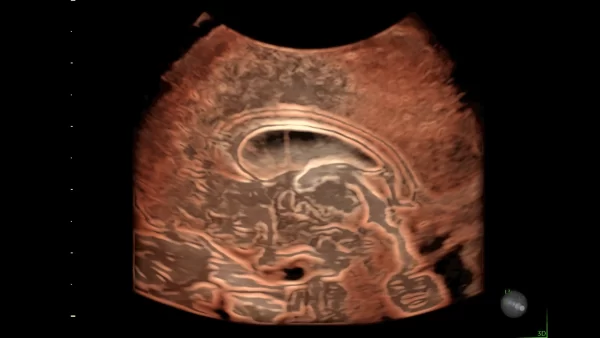fetus brain image