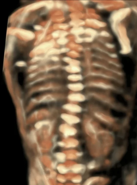 fetus-scoliosis-image