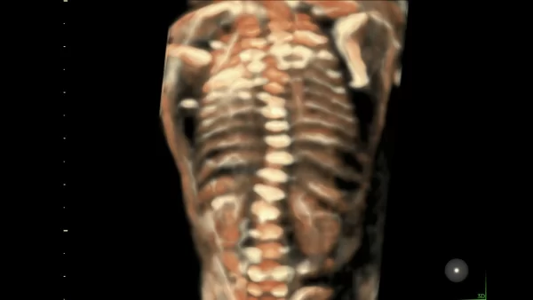 fetus scoliosis image