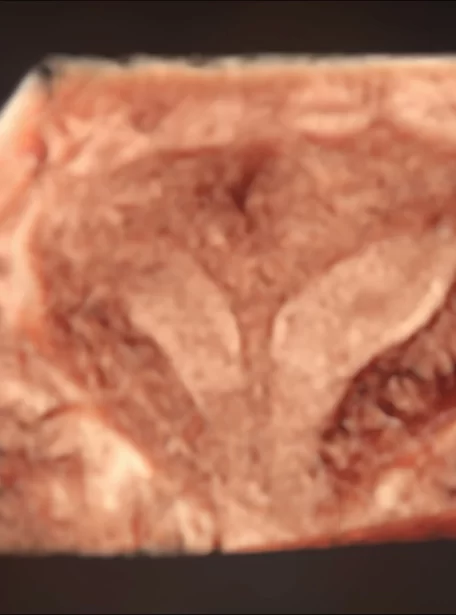 septate-uterus