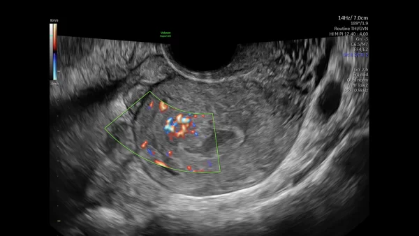 uterus radiantflow